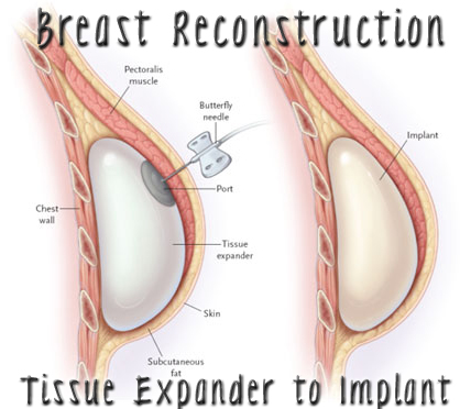 My Breast Reconstruction Journey Phase One Tissue Expanders